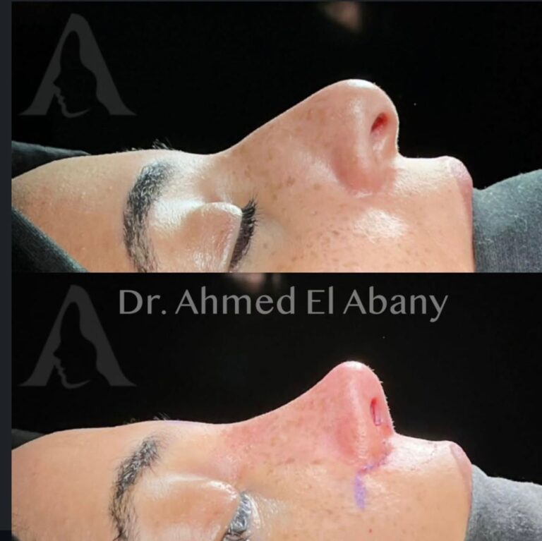 Rhinoplasty before and afters